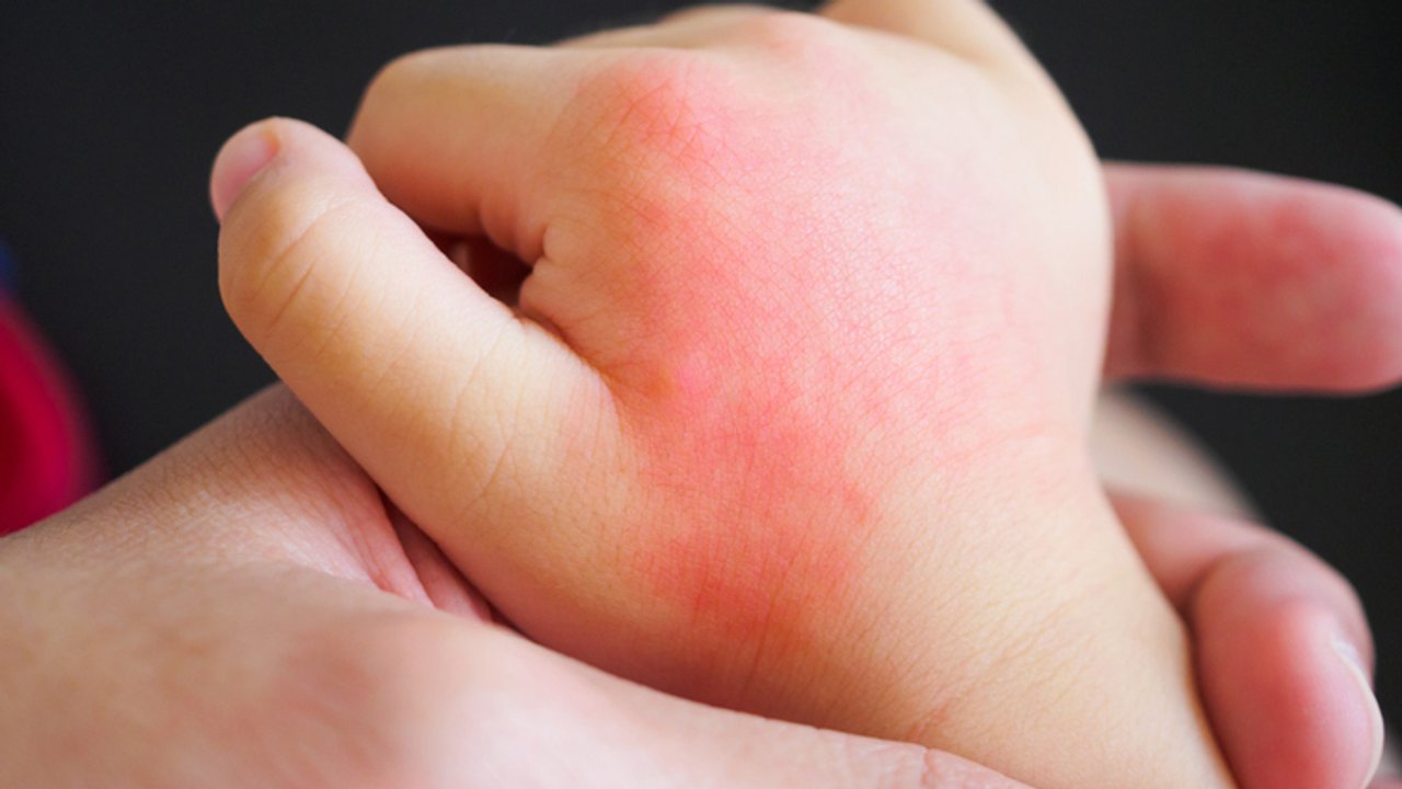 Arzneimittelallergie
