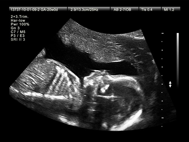SSW 19 / SSW 20 Ultraschallbild vom Baby