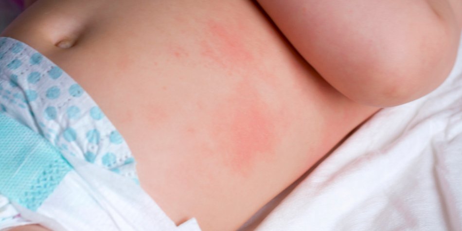 Windeldermatitis Windeldermatitis