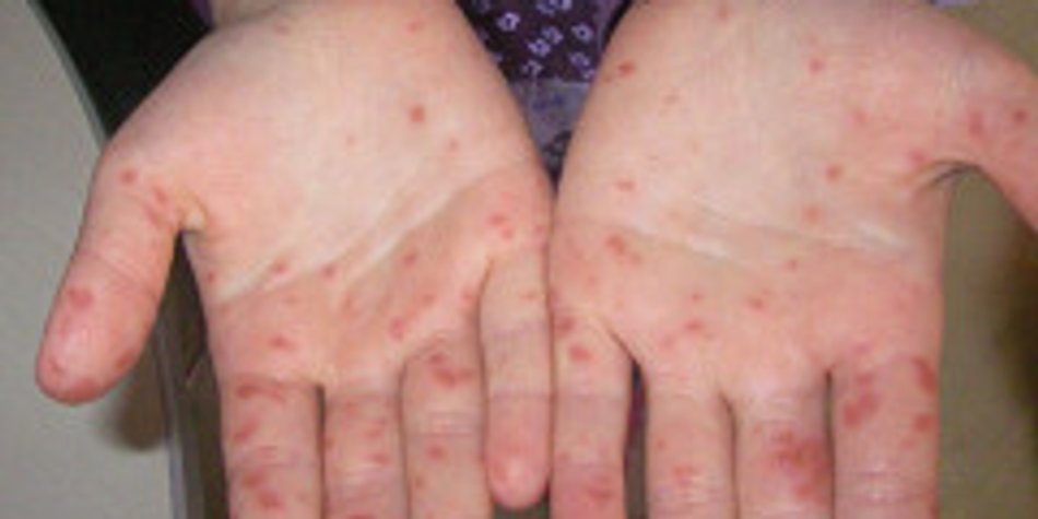 Hand-Mund-Fuß-Krankheit: Symptome, Bilder & Behandlung Hand-Mund-Fuß-Krankheit: Symptome, Bilder & Behandlung