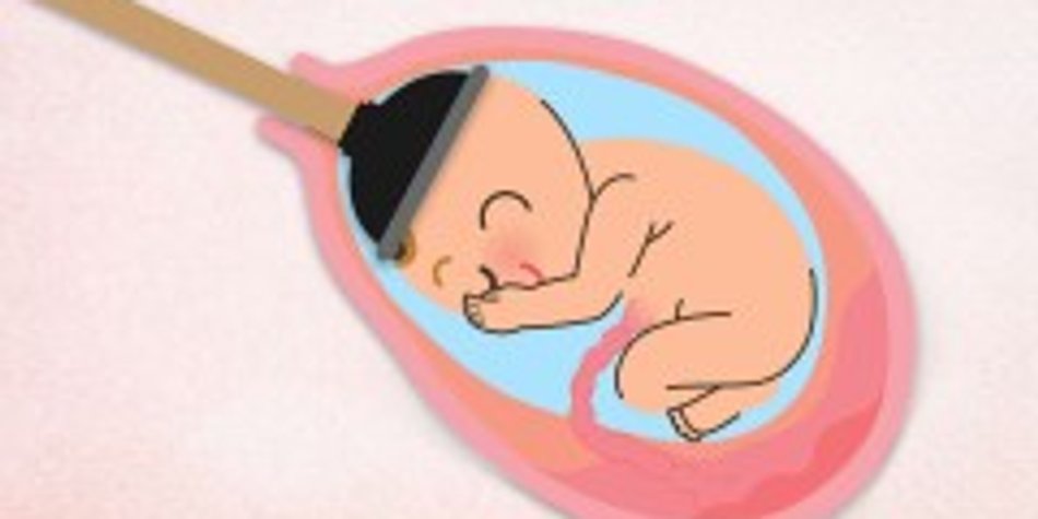 Saugglocke: Wenn bei der Geburt nachgeholfen werden muss Saugglocke: Wenn bei der Geburt nachgeholfen werden muss