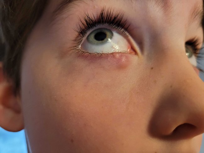 Kind mit Gerstenkorn am Auge Kind mit Gerstenkorn am Auge