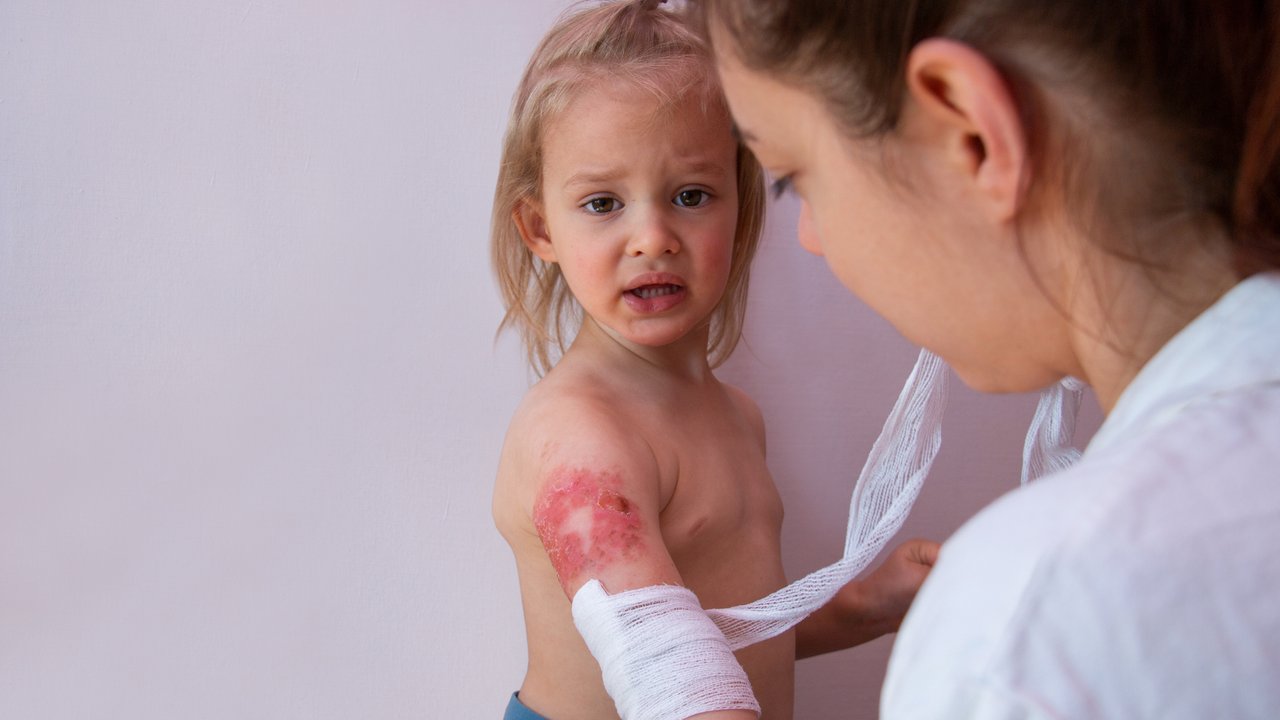 Child burn injury, burns treatment and healing, pediatrician is dressing wound on toddler arm with a sterile non-adhesive bandage