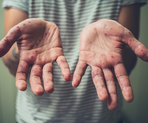 Hand-Fuß-Mund-Krankheit