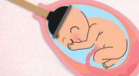 Saugglocke: Wenn bei der Geburt nachgeholfen werden muss