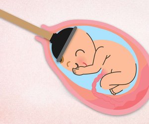 Saugglocke: Wenn bei der Geburt nachgeholfen werden muss