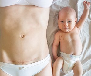 Kaiserschnittnarbe: So verheilt sie gut und unauffällig