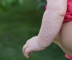 Mückenstich beim Baby und Kleinkind richtig behandeln