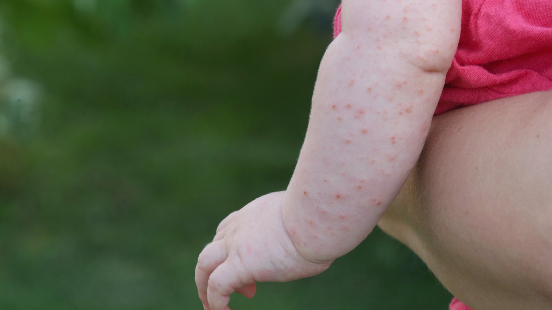 m-ckenstich-beim-baby-kleinkind-das-hilft-wirklich