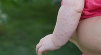 Mückenstich beim Baby und Kleinkind richtig behandeln