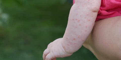 Dellwarzen bei Kindern - Homopathie kann helfen