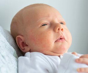 Neugeborenenakne – oder doch nicht?