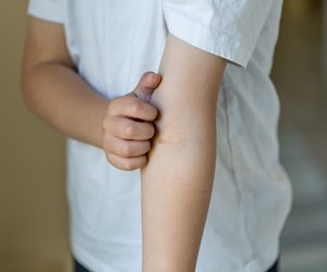 Die Symptome bei Schuppenflechte und empfehlenswerte Behandlung