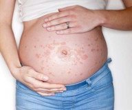 PUPP-Syndrom: Juckender Ausschlag in der Schwangerschaft