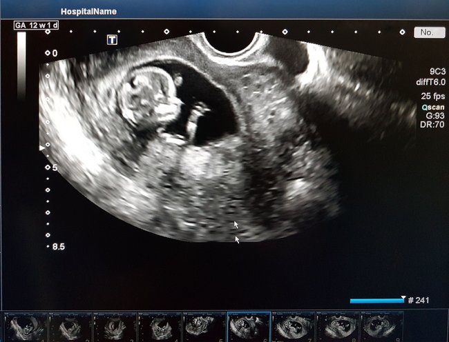 12+1: Auf diesem Ultraschallbild siehst du ein Baby in der 13. SSW