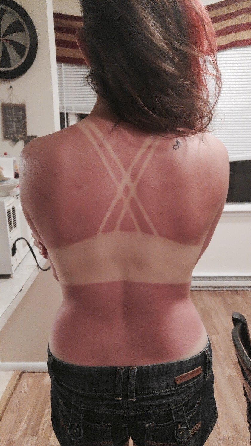 Sonnenbrand Sonnen Bikini