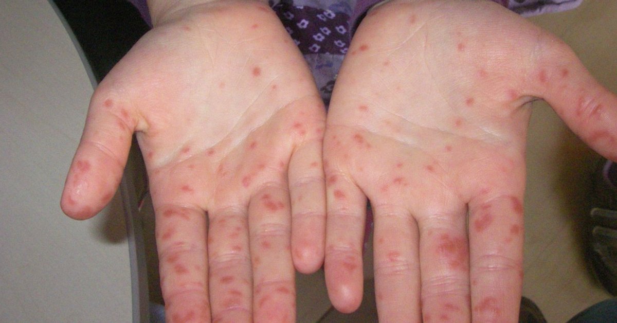 Hand Mund Fuss Krankheit Symptome Bilder Behandlung Familie De