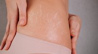 Dehnungsstreifen lasern lassen: Diese Möglichkeiten gibt es
