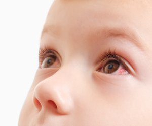 Diese Symptome deuten auf eine Augenentzündung beim Kind hin