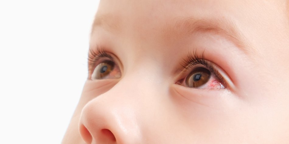 Diese Symptome deuten auf eine Augenentzündung beim Kind hin