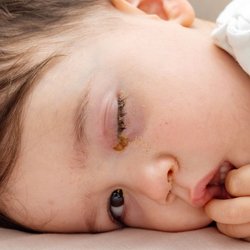 Oh no, Bindehautentzündung! Was deinem Kind jetzt hilft  – und wie lange die Kita tabu ist