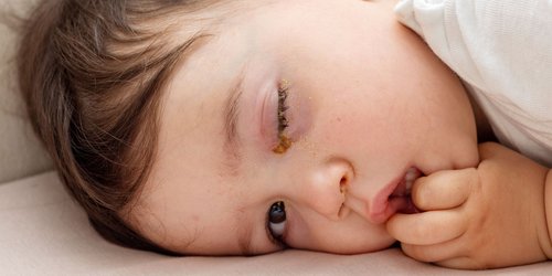 Oh no, Bindehautentzündung! Was deinem Kind jetzt hilft  – und wie lange die Kita tabu ist
