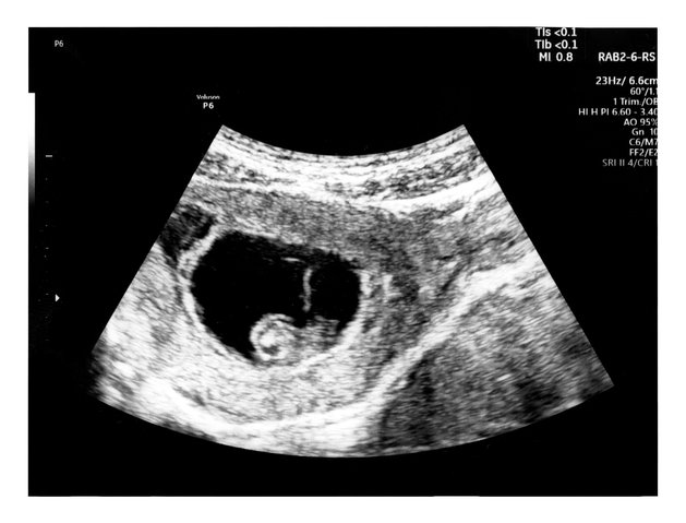 Ultraschall siebte schwangerschaftswoche 9. SSW