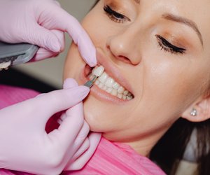 Veneers Haltbarkeit: So lange hast du Freude an der Zahnoptimierung