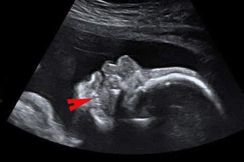 Ultraschallbilder Was Kann Man Erkennen Familie De