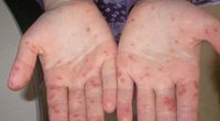 Hand-Mund-Fuß-Krankheit: Symptome, Bilder & Behandlung