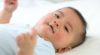 Nesselsucht beim Kind: Das hilft bei brennendem, juckenden Ausschlag
