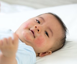 Nesselsucht beim Kind: Das hilft bei brennendem, juckenden Ausschlag