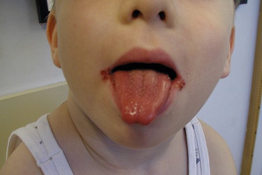Belegte zunge braun Zungenbelag: verhindern