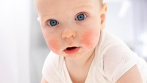 Trockene, entzündete Haut bei Babys und Kindern: Hautärzte sagen, was wirklich hilft