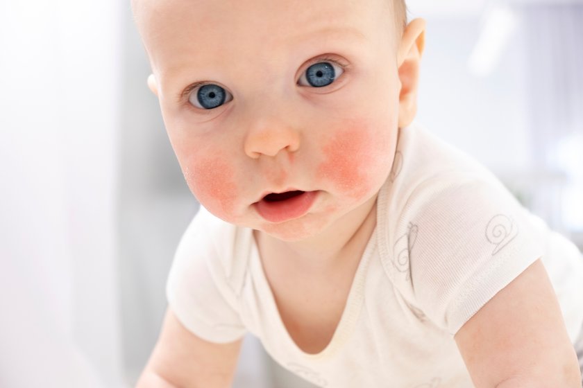 Baby face with eczema on cheeks. Atopic dermatitis. Dry skin, rash, itch and other dermatology problems. Baby skin care, diagnosis, medical treatment and therapy. Allergic reaction.
