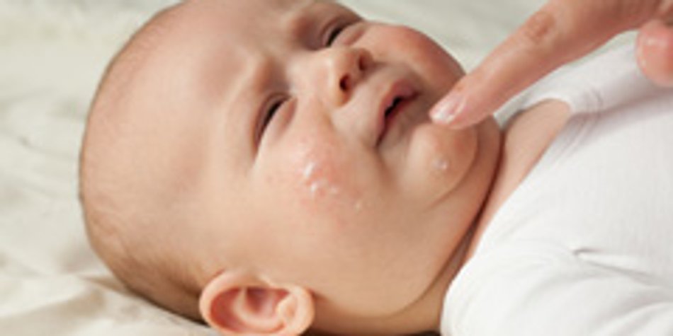 Neurodermitis: Wenn Babys Haut juckt