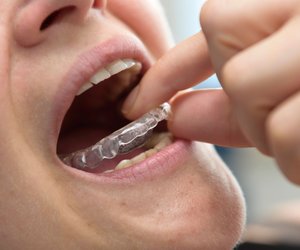 Knirschschiene reinigen – so wird der unsichtbare Helfer wieder sauber