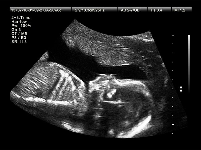 Ein Baby in SSW 20+1 im Ultraschall