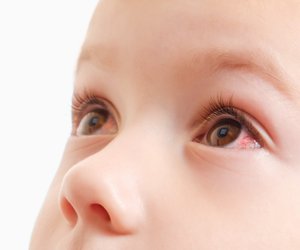 Bindehautentzündung bei Kindern: Vorbeugung, Symptome und wie sie behandelt wird