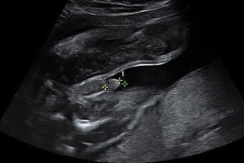 Ultraschallbild von einem Jungen