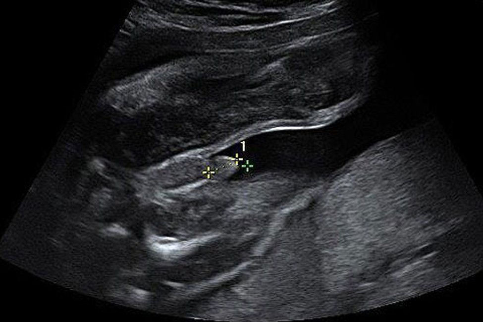 Junge ultraschall 12 ssw Ultraschallbilder