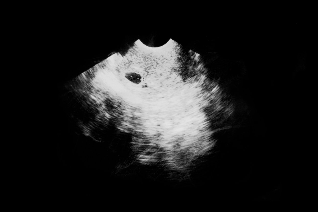 Ultraschall in der Schwangerschaft Was sieht man in welcher SSW?