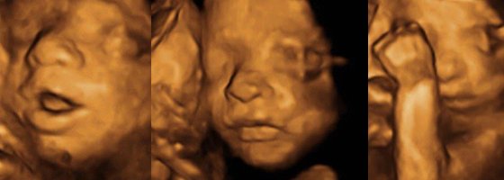 3D-Ultraschall: Alle Infos zu Kosten, Risiken und Zeitpunkt