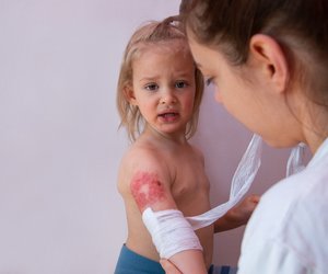 Verbrennungs-Fallen&#x3A;&#x20;Diese&#x20;Fehler&#x20;machen&#x20;Eltern&#x20;oft&#x20;unbewusst,&#x20;warnt&#x20;ein&#x20;Kinderchirurg