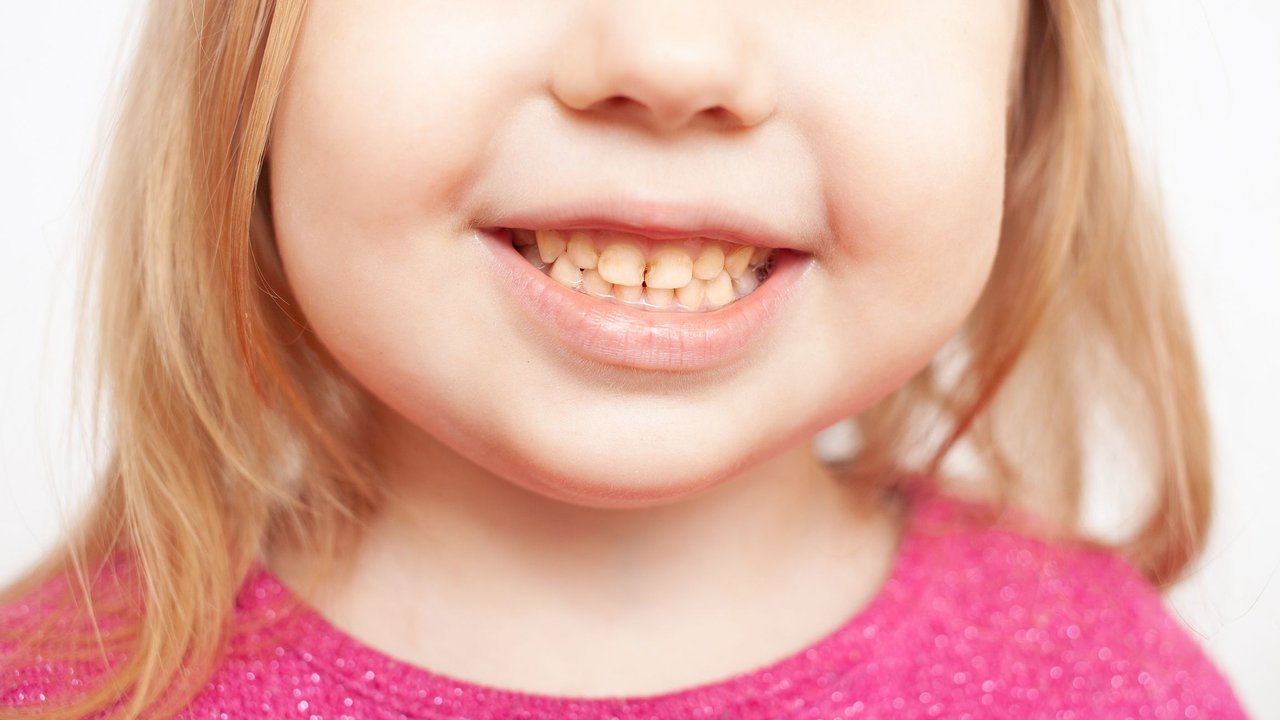 Gelbe Zähne bei Kindern