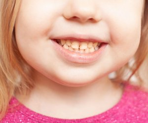 Gelbe Zähne bei Kindern: Woher sie kommen und was dagegen hilft