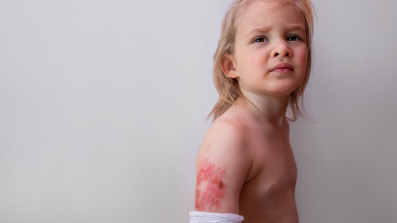 Brandblase behandeln: Kind mit Brandwunde