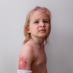 Erste&#x20;Hilfe&#x20;bei&#x20;Brandblasen&#x3A;&#x20;Was&#x20;Eltern&#x20;sofort&#x20;tun&#x20;sollten