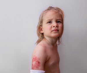 Brandblase behandeln: Tipps vom Kinderchirurgen, damit die Haut schnell heilt