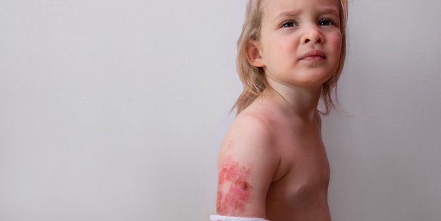 Brandblase behandeln: Erste Hilfe-Tipps vom Kinderchirurgen, damit die Haut schneller heilt